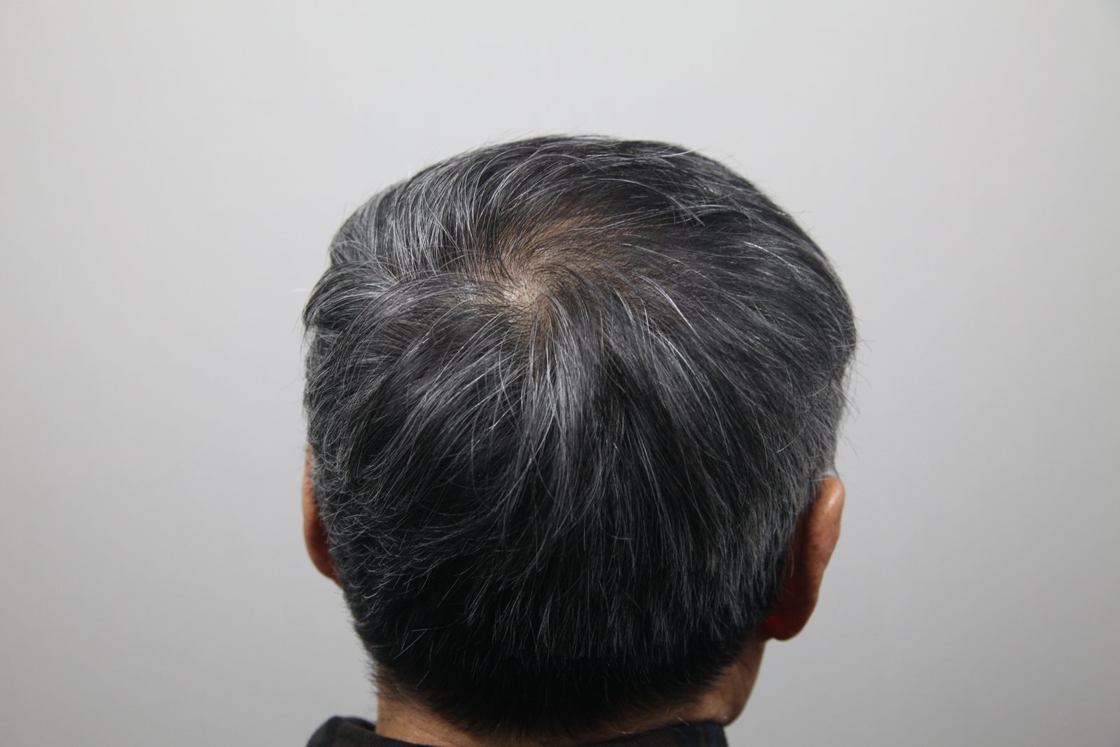 Crown transplant after, MONARA Dermatology Clinic
