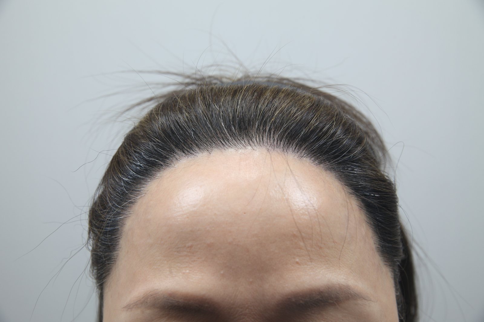 Female hairline after, MONARA Dermatology Clinic