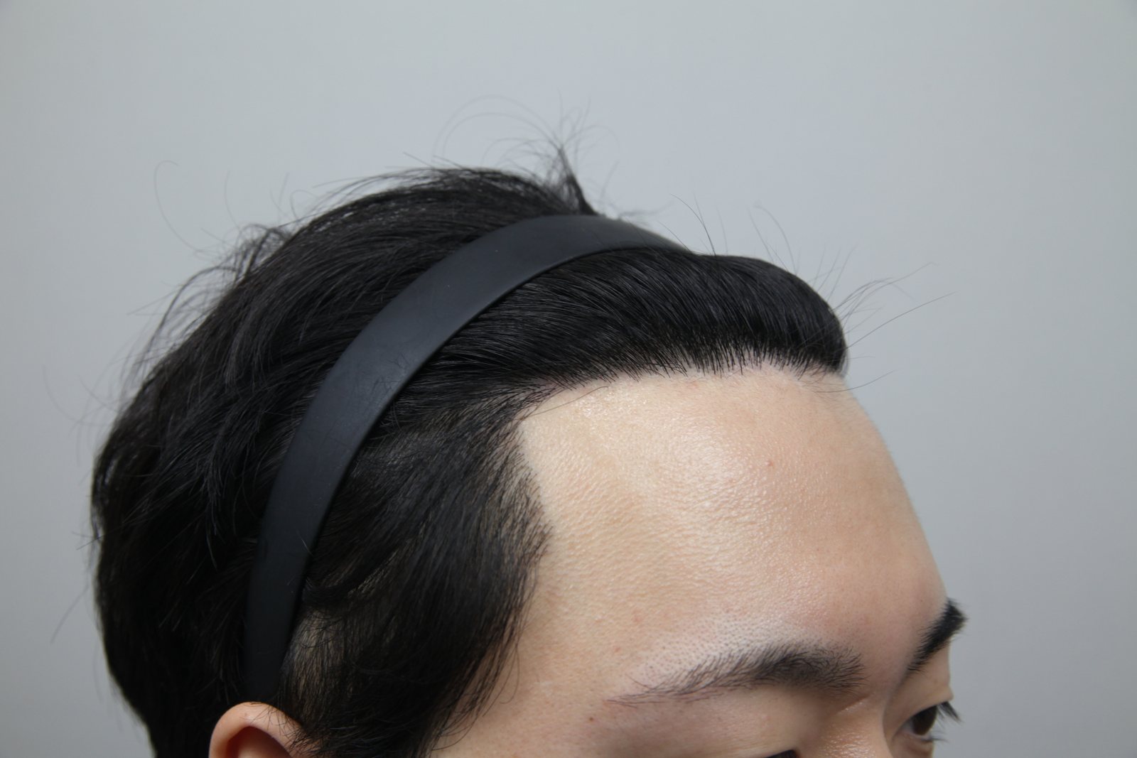 FUE hair transplant after, MONARA Dermatology Clinic